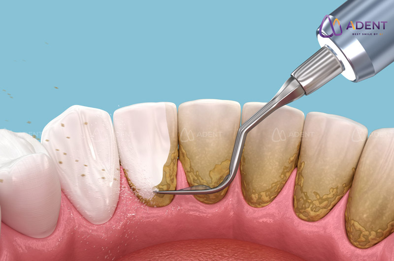 Vai trò của lấy cao răng trong chăm sóc răng miệng