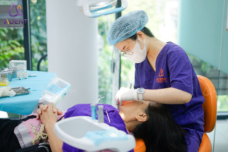 Bao lâu nên lấy cao răng 1 lần