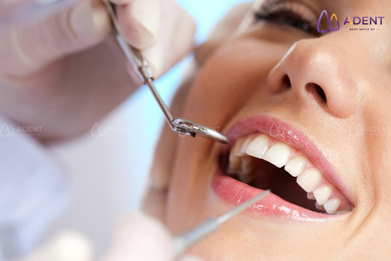 Vai trò của lấy cao răng