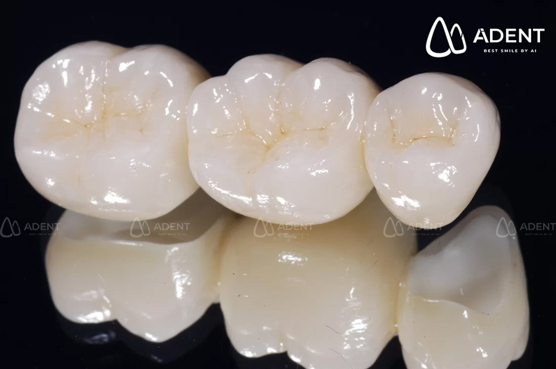 Giá thành Răng sứ kim loại và răng toàn sứ