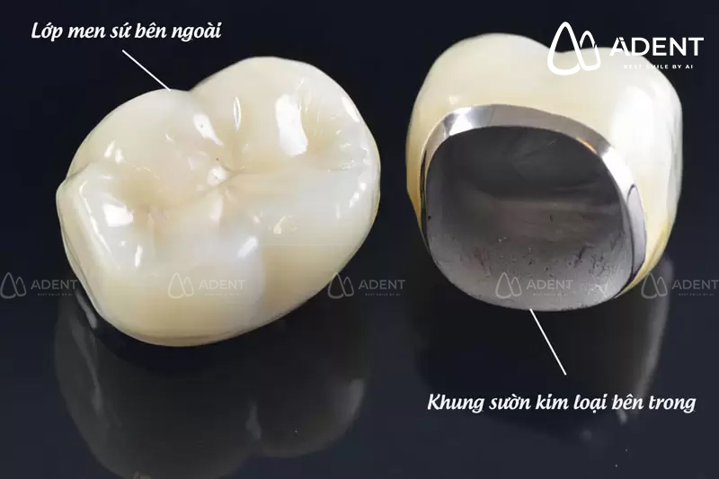 Răng sứ kim loại là gì?