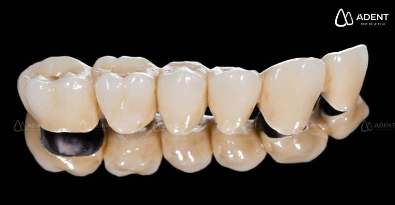 Ưu điểm của răng sứ kim loại