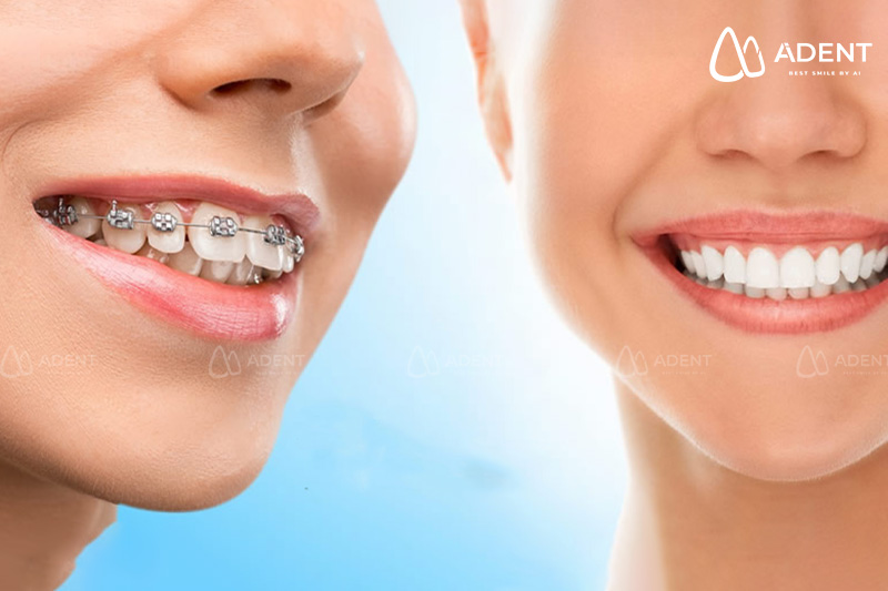 Hướng dẫn cách vệ sinh răng miệng khi niềng răng