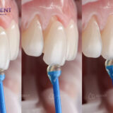 ới veneer, cảm giác ê buốt thường rất nhẹ hoặc không có