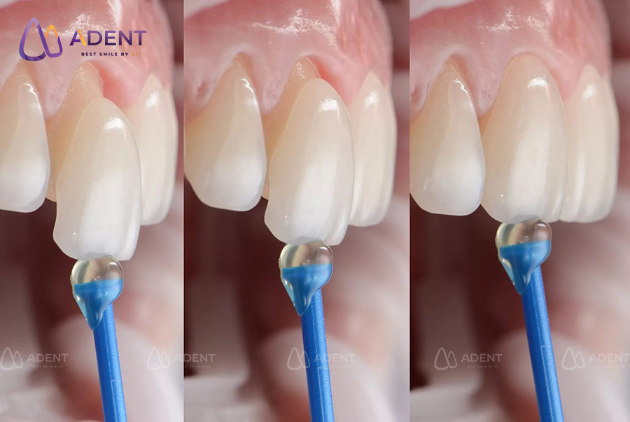 ới veneer, cảm giác ê buốt thường rất nhẹ hoặc không có