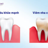 Viêm nha chu là gì?