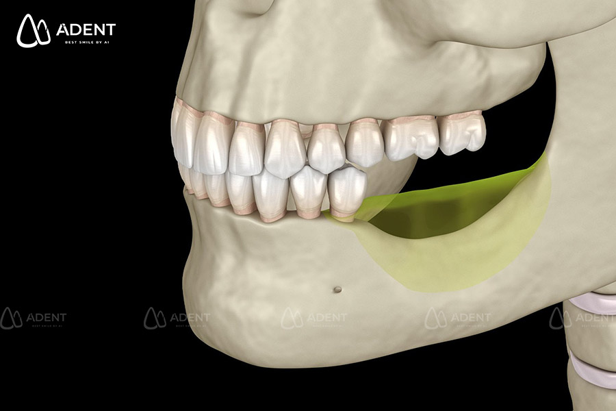 Vì sao người lớn tuổi nên làm hàm tháo lắp sớm thay vì chờ mất hết răng?