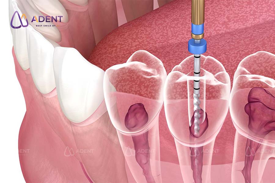 Điều trị tủy có ảnh hưởng đến sức khỏe toàn thân không?