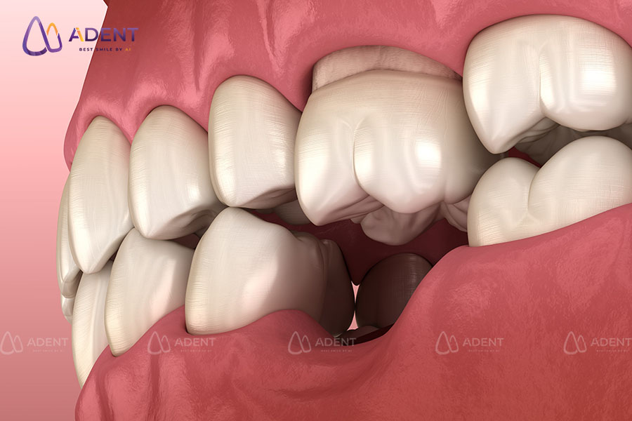 Mất răng lâu năm có còn làm được hàm tháo lắp không?