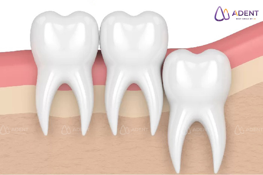 Răng khôn mọc thẳng có cần nhổ không?