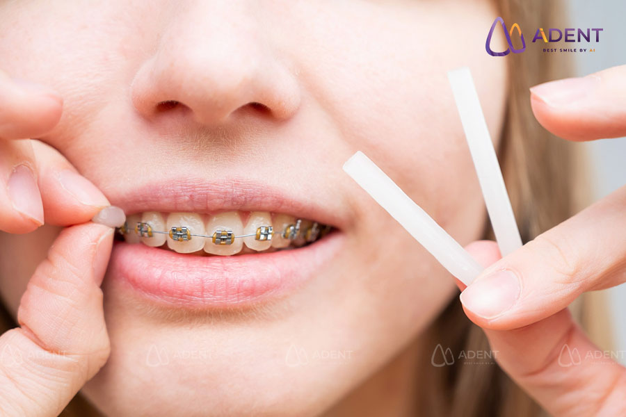 Tips giảm đau sau khi gắn mắc cài trong những ngày đầu niềng răng